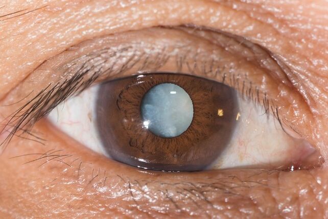 For cataracts, exercises to improve vision are indicated.
